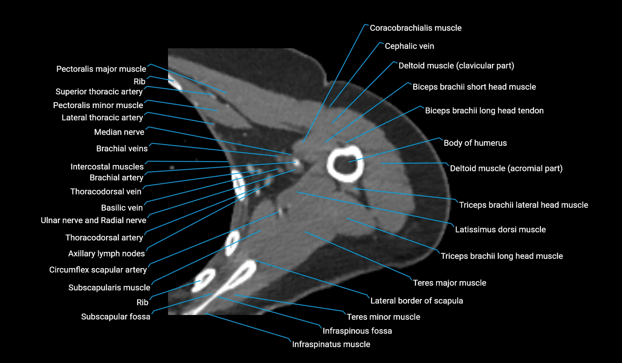 CT upper arm axial  cross sectional anatomy labelled radiology image -00144.webp